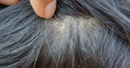 Are head lice black?